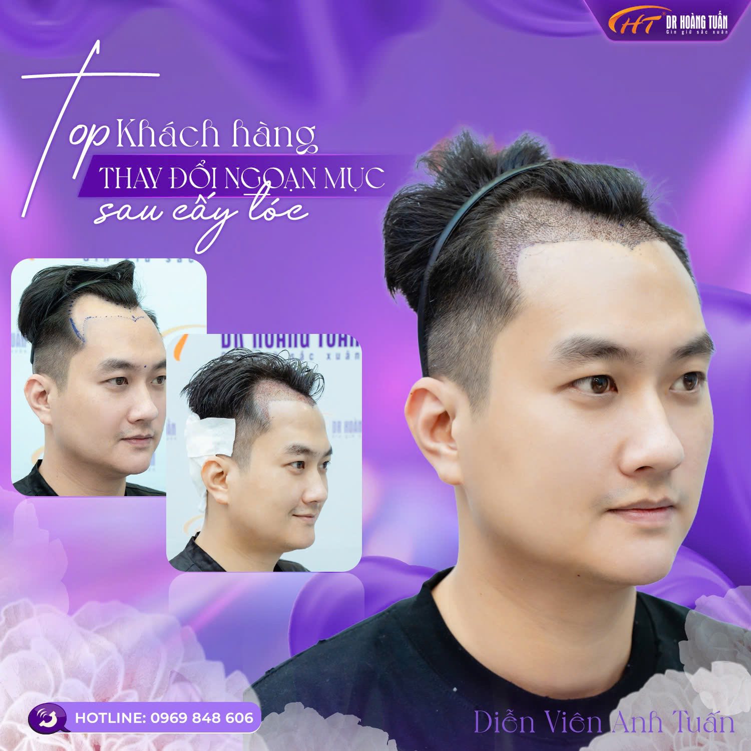 khách hàng cấy tóc hói chữ m tại dr hoàng tuấn